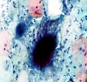 Actynomices in un preparato citologico con colorazione Papanicolau -actinomyces donne