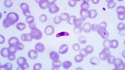 Figura 1 - Striscio di sangue che evidenzia la presenza del parassita Plasmodium falciparum