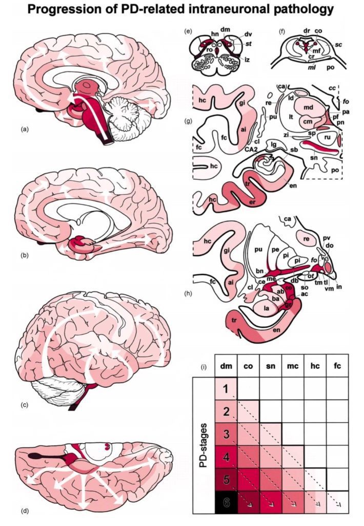 Figura 4. Stadiazione di Braak. L'immagine sopra riporta il sistema di stadiazione di Braak, basato sull’idea che la progressione della patologia, che origina da strutture non dopaminergiche, avviene in 6 stadi ed è topograficamente prevedibile. L’intensità del colore cresce proporzionalmente all’aumento della densità dei corpi di Lewy osservabili in quella regione. La freccia bianca indica il coinvolgimento graduale delle strutture correlate