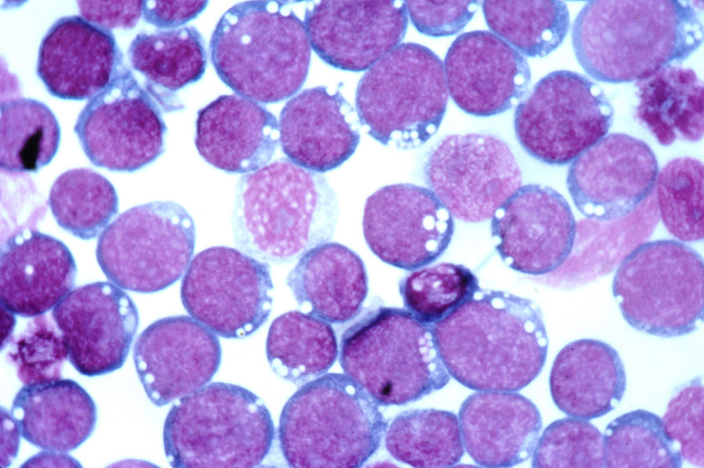 EpsteinBarr virus e sclerosi multipla il nuovo studio sierologico