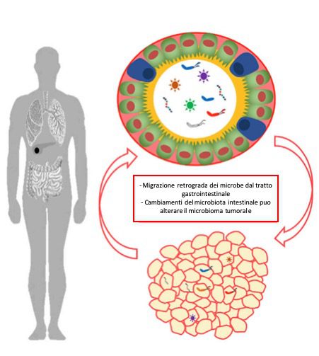 I microbi intestinali possono traslocarsi nei tumori direttamente attraverso il tratto gastrointestinale e / o per ematogeno diffusione. I tumori possono anche avere un impatto diretto sul microbioma intestinale, sebbene il meccanismo alla base di questo non sia ben caratterizzato.
