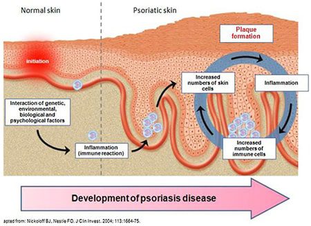 Sviluppo della patologia da psoriasi