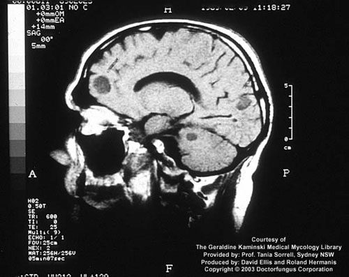 Lesioni cerebrali conseguenti all'infezione criptococcica