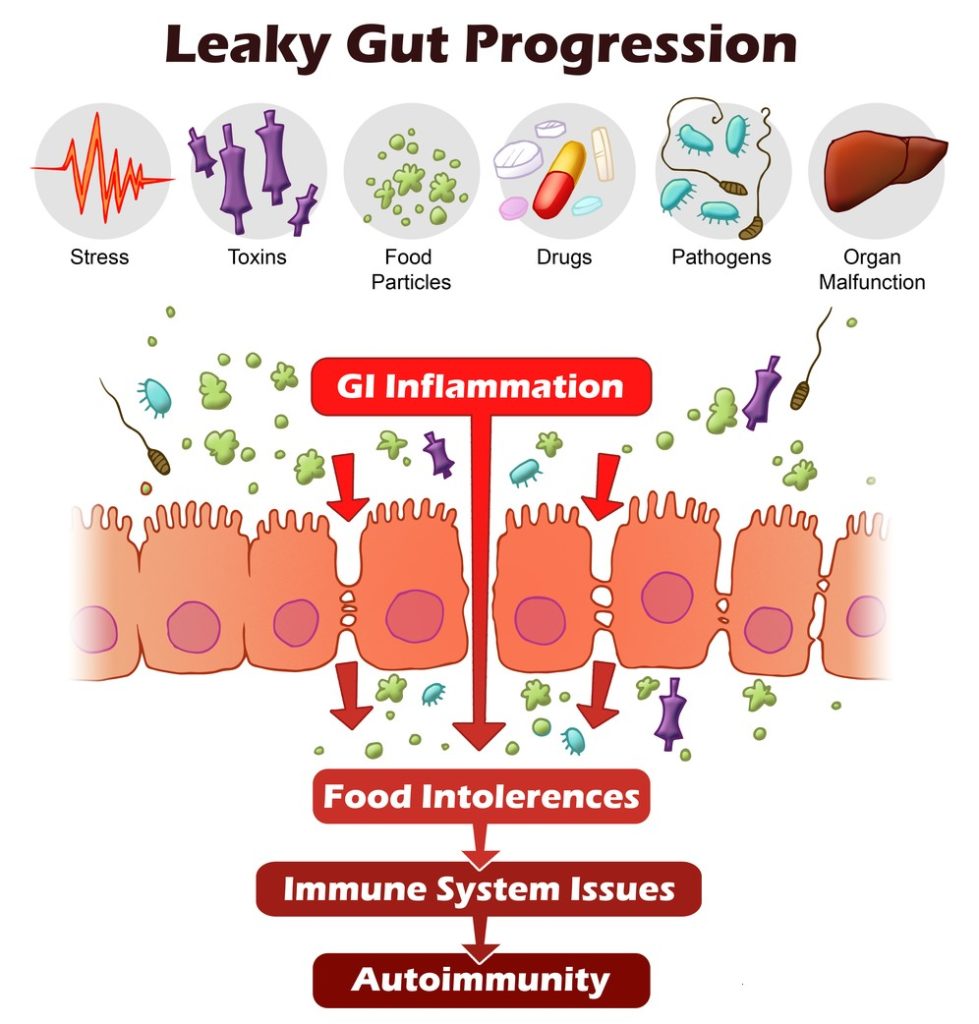 La sindrome dell'intestino permeabile