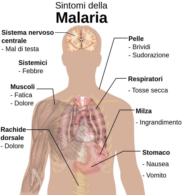  Sintomi della malaria comuni alle diverse specie di plasmodio, tra cui Plasmodium falciparum.