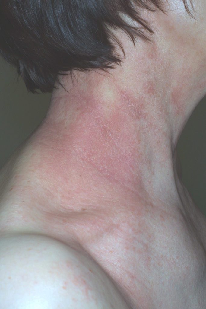 Tipiche lesioni da dermatite atopica