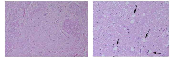 prioni: a sinistra è mostrato il tessuto nervoso di un bovino sano, a destra il tessuto nervoso di un bovino affetto da BSE, le frecce nere indicano la vacuolizzazione (perdita neuronale) del tessuto caratteristica comune di tutte le EST.