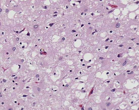 prioni: Corteccia cerebrale di un paziente affetto da vCJD, le aree bianche sono il risultato della perdita neuronale