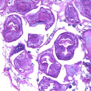 Idatide alveolare in una sezione istologica del fegato