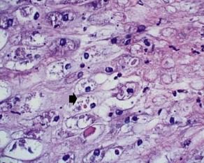 Biopsia cutanea colorata con ematossilina-eosina che mostra i corpi di Guarnieri nelle cellule dell’epidermide (indicati dalla freccia nera)