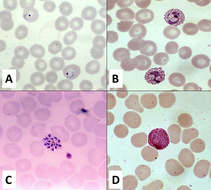 Stadi di sviluppo eritrocitario di Plasmodium vivax
