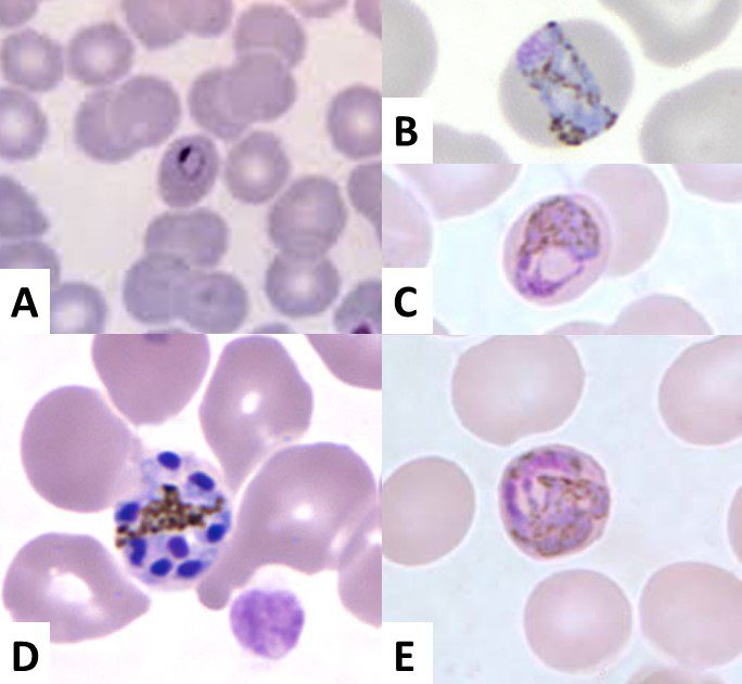 Stadi dello sviluppo eritrocitario di Plasmodium malariae
