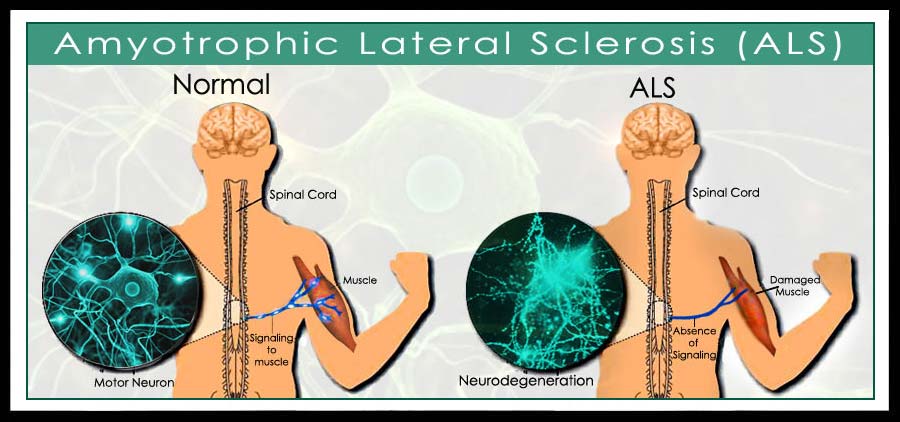 La sclerosi multipla è una patologia progressiva che colpisce in maniera degenerativa i neuroni motori centrali e periferici.