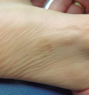 Lesione maculare marrone chiaro sulla pianta del piede [Marìa Consuelo Giordano L. et al., 2018]