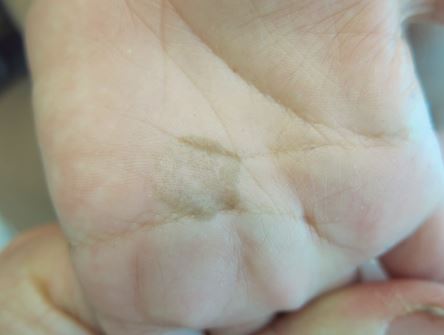 Macula pigmentata sul palmo della mano [Marìa Consuelo Giordano L. et al., 2018]