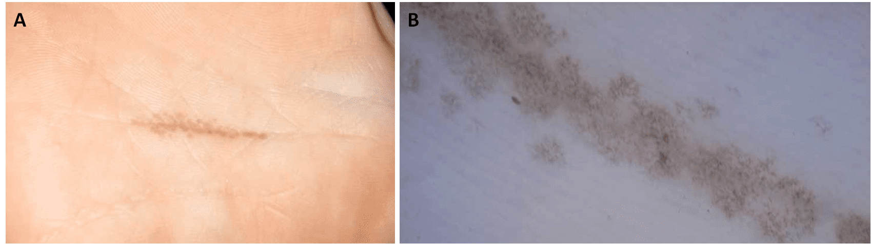 Lesione caratteristica della tinea nigra, all’esame fisico (A) e all’esame dermatoscopico (B) [https://www.dermatologyadvisor.com/home/decision-support-in-medicine/dermatology/tinea-nigra-tinea-nigra-palmaris-tinea-nigra-plantaris-pityriasis-nigra-keratomycosis-nigricans-palmaris/]