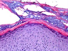 Biopsia cutanea colorata con ematossilina-eosina  [https://www.dermatologyadvisor.com/home/decision-support-in-medicine/dermatology/tinea-nigra-tinea-nigra-palmaris-tinea-nigra-plantaris-pityriasis-nigra-keratomycosis-nigricans-palmaris/]