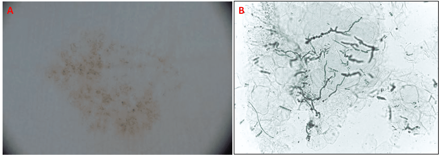 Esame dermatoscopico (A) ed esame microscopico (B) della lesione; il primo mostra vari “fili” marroni intersecati (segno di lesione non melanocitica), nel secondo si osservano ife settate e pigmentate [Marìa Consuelo Giordano L. et al., 2018]