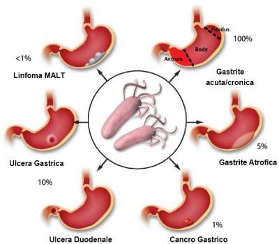 Gastrite Caratteristiche Eziologia Epidemiologia Diagnosi Terapie Gastrite Caratteristiche Eziologia Epidemiologia Diagnosi Terapie