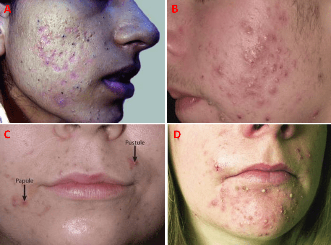 Figura 5 – Lesioni tipiche dell’acne vulgaris