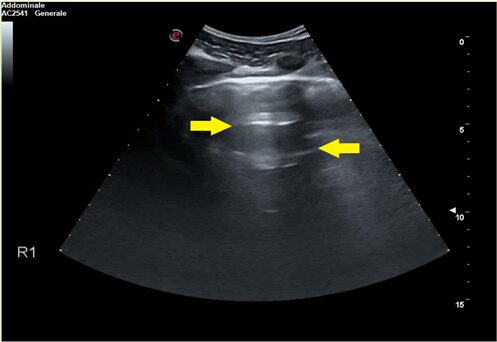 Questa &egrave; un&rsquo;area di tessuto polmonare normale: sono presenti le linee A (frecce gialle) date dalla riflessione degli ultrasuoni sulla pleura.
