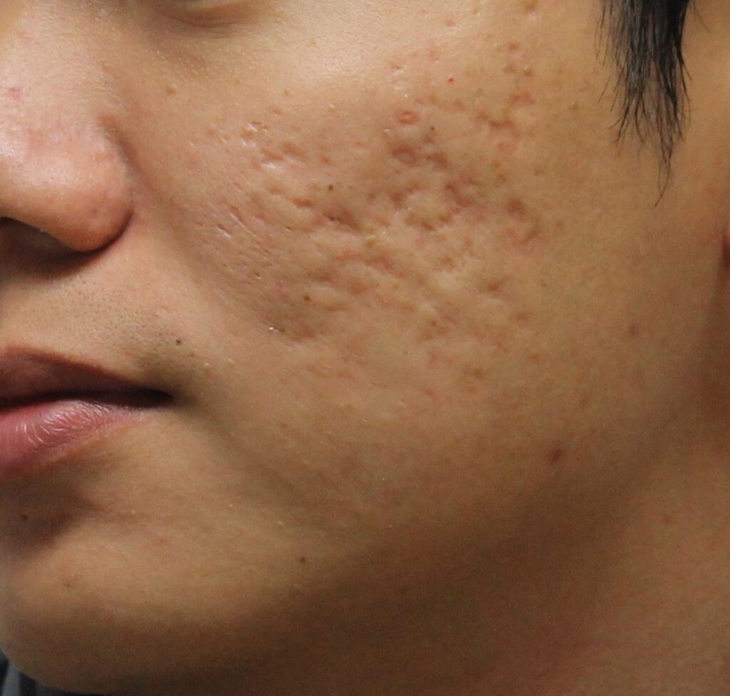 Profonde cicatrici causate dall'acne