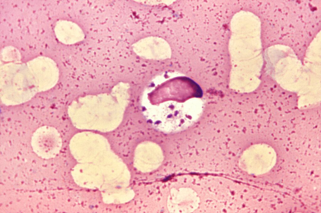 Leishmania donovani nelle cellule del midollo osseo