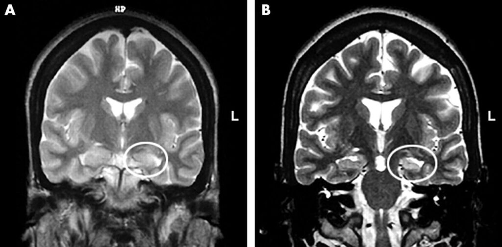 Risonanza magnetica nucleare (MRI) su paziente con epilessia temporale