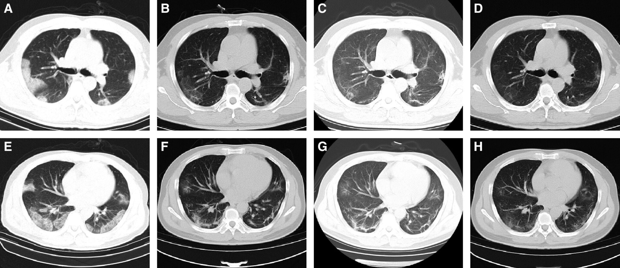 Fibrosi polmonare post covid19 patologia cronica o reversibile?