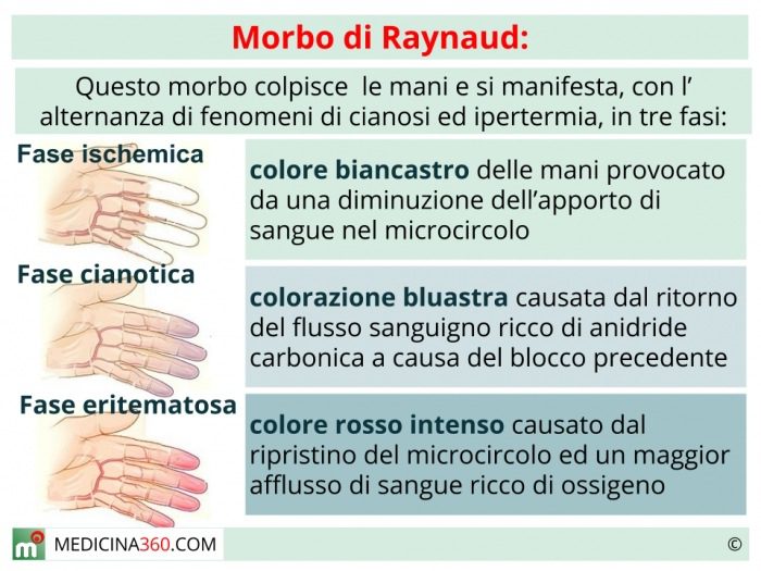 Figura 2 - Le tre fasi attraverso le quali si verifica il tipico cambiamento di colore del Fenomeno di Raynaud