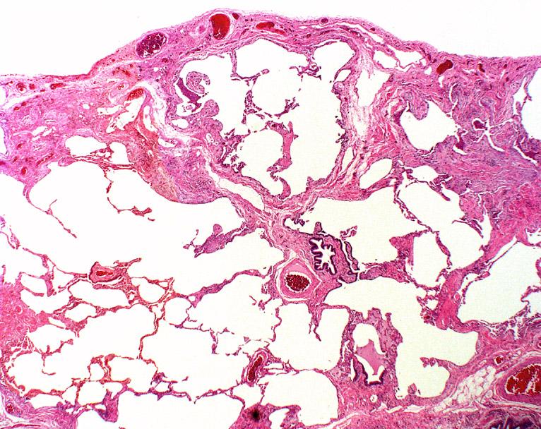 tessuto polmonare in fibrosi