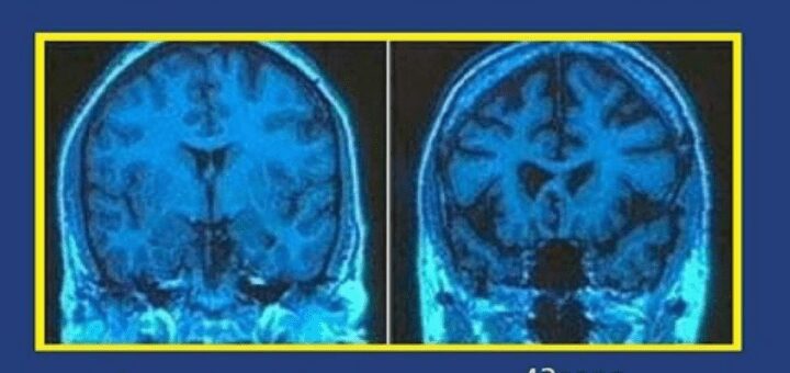 In questa risonanza magnetica encefalica possiamo confrontare gli effetti dell'alcol in due individui, uno sano (a sinistra) e l'altro alcoldipendente (a destra). La tonalità di colore blu indica il livello di attività cerebrale. Sul lato destro si può vedere un cervello danneggiato. Nelle zone nere, il cervello è totalmente inattivo. Si nota, inoltre, che nelle zone blu attive che funzionano ancora, c'è una generale diminuzione di luminosità: anche la funzionalità dei neuroni che sono ancora attivi risulta compromessa.