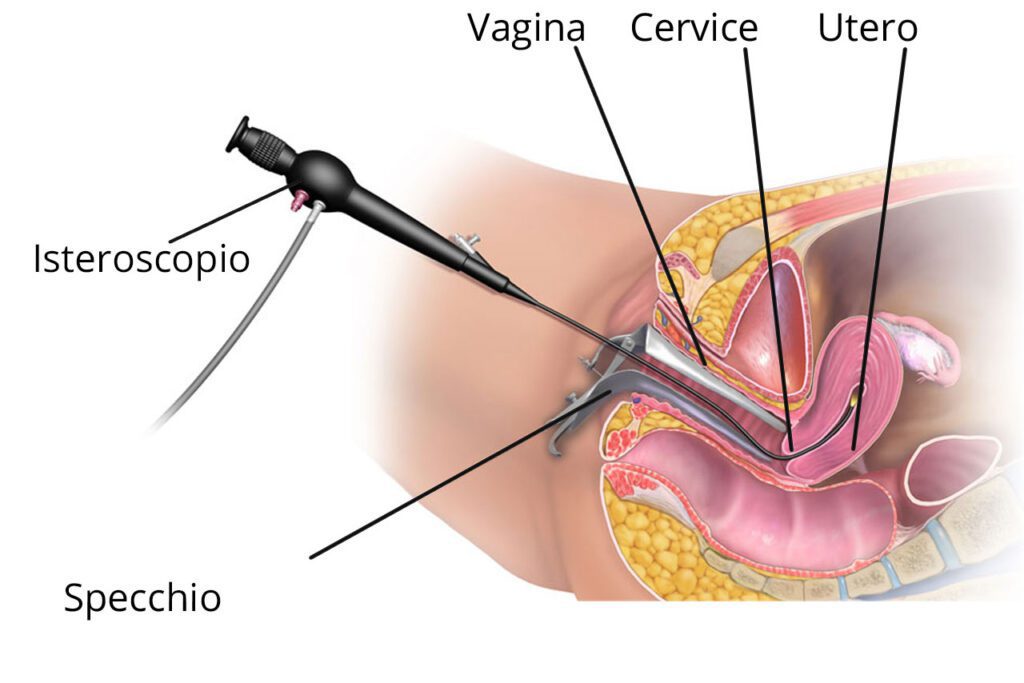 L'isteroscopia permette una visualizzazione diretta dell’endometrio, grazie a una telecamera posizionata all'estremità di un sottile strumento, introdotto all’ interno dell’organo attraverso un orifizio localizzato sulla cervice. Questa procedura consente anche di prelevare piccoli campioni di tessuto (biopsia). - cancro dell'endometrio