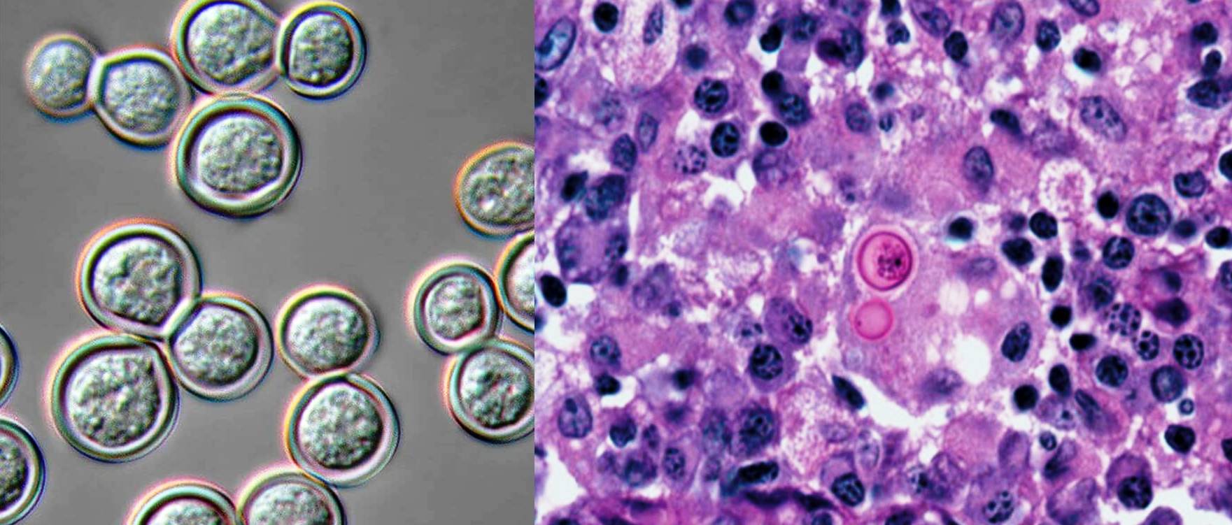 Blastomyces dermatitidis