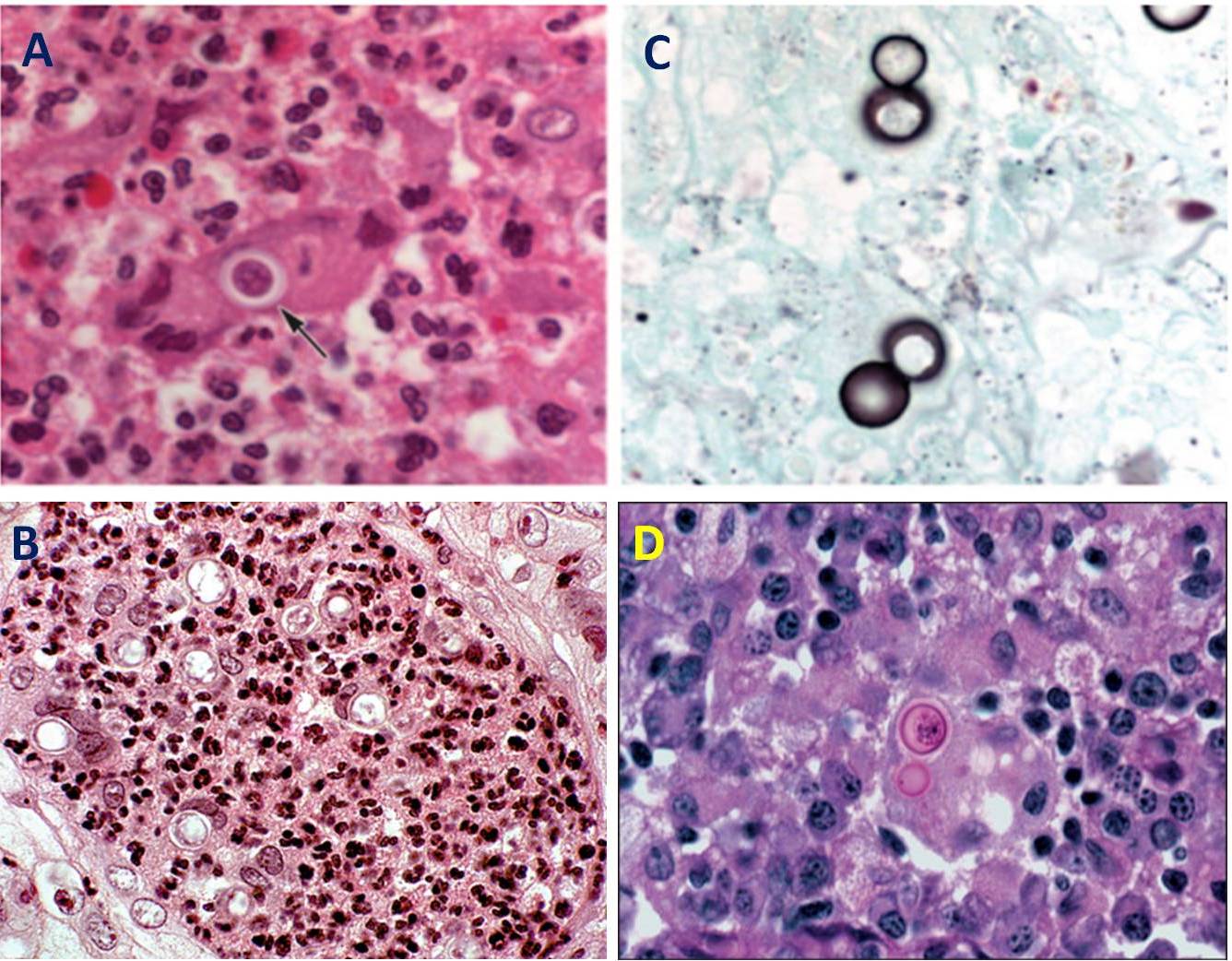 Figura 8 – Sezioni istologiche colorate con Ematossilina-Eosina (A e B), Grocott-Gomori (C) e reazione PAS (D). Nell’immagine A si notano varie cellule di B. dermatitidis circondate da polimorfonucleati ben evidenti, mentre nell’immagine B una singola cellula dalla spessa parete (freccia) si trova all’interno di un tessuto granulomatoso. L’immagine C mostra delle cellule in via di riproduzione in cui la cellula figlia è grande quanto la cellula madre, mentre nell’immagine D si osservano due cellule, madre e figlia, all’interno di un granuloma necrotizzante