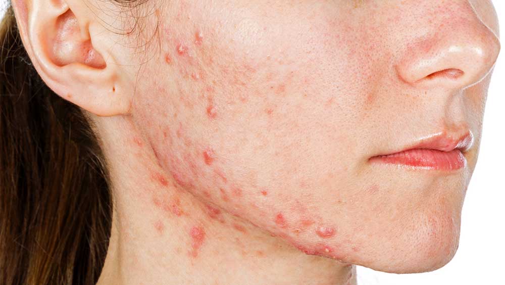 Figura 2 : soggetto con Acne vulgaris [Fonte dermatologyadvisor]