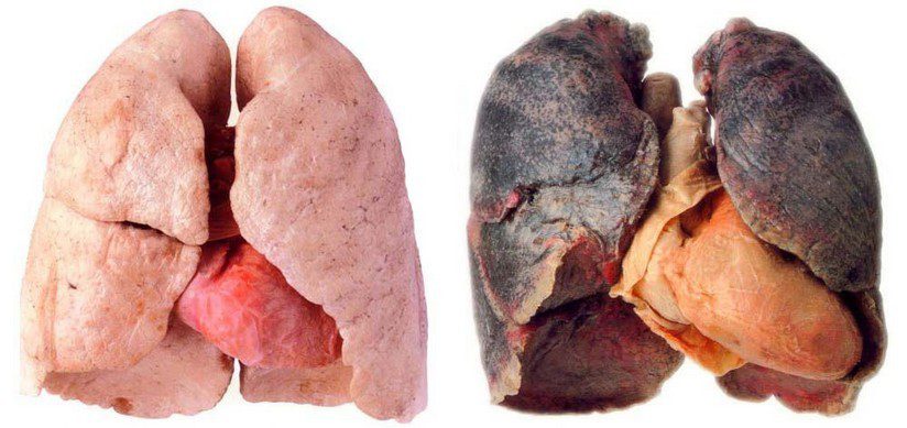 Differenza tra polmoni sani e danneggiati dal fumo
