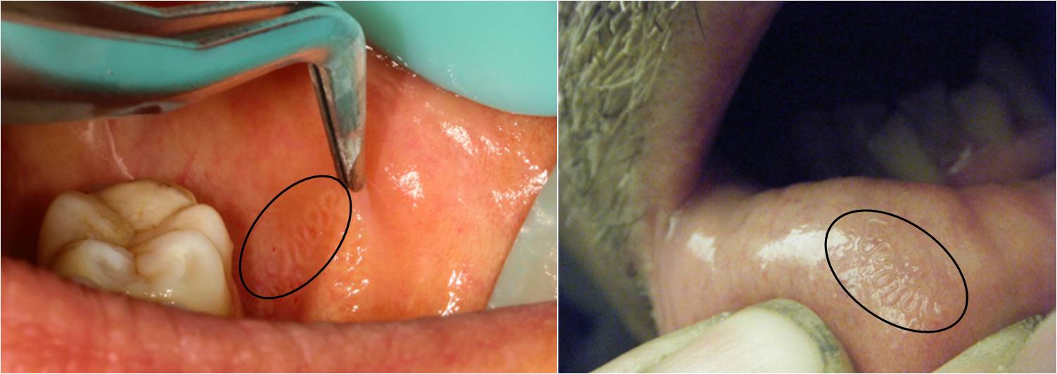Figura 3 – Movimento serpentino di G. puchrum nella mucosa orale 