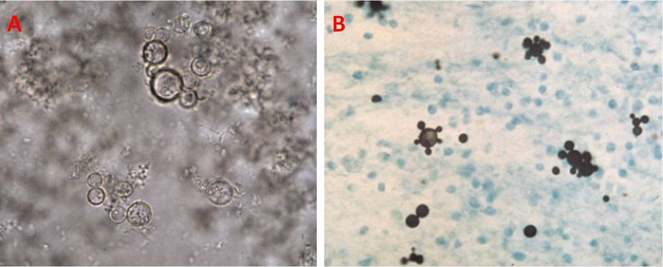 Figura 12 – Cellule di P. brasiliensis in un campione di espettorato trattato con KOH (A) e in un campione di aspirato linfonodale colorato con Grocott-Gomori (B)