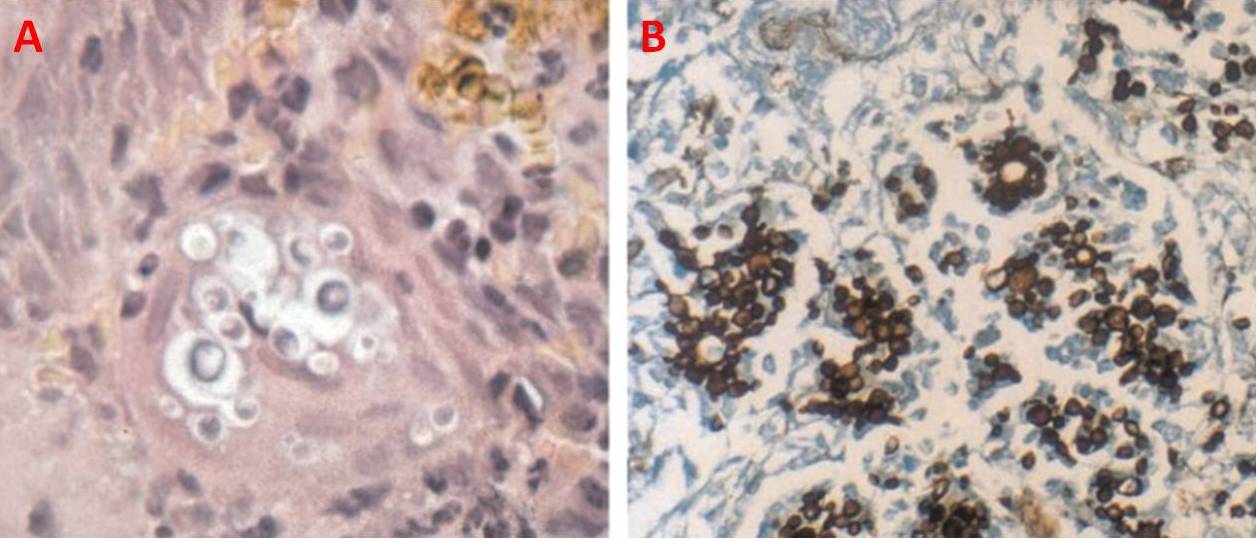 Figura 13 – Istopatologia della PMC in cui si vedono le cellule fungine all’interno dei tessuti. Colorazione con reazione PAS (A) e con Grocott-Gomori (B)