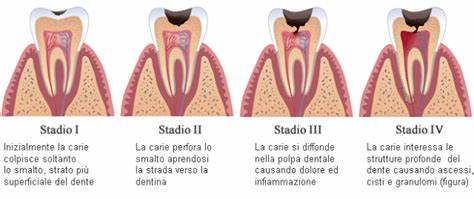 Progressione della carie dentale