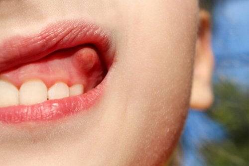 Esempio ascesso dentale