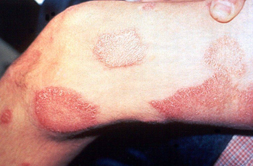 Lesione cutanee eritematose tipiche della Malattia di Hansen