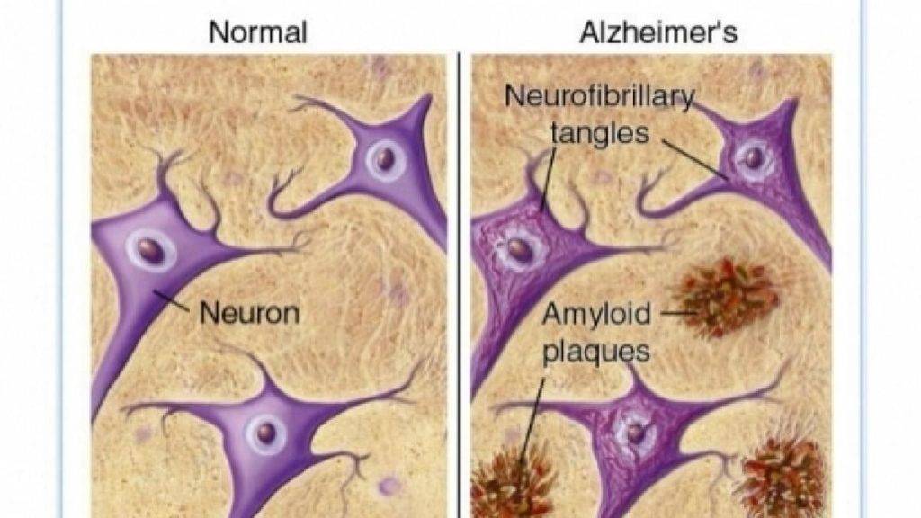 Il&nbsp;cervello&nbsp;dei pazienti affetti dalla malattia di Alzheimer &egrave; caratterizzato dalla deposizione delle cosiddette&nbsp;placche senili, costituite da aggregati di&nbsp;proteina beta-amiloide&nbsp;che deriva da una proteina precursore.