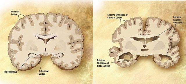 La corteccia cerebrale si accartoccia, danneggiando le aree coinvolte nel pensiero, nella pianificazione e nel ricordo. Questo fenomeno avviene soprattutto nell&rsquo;ippocampo, l&rsquo;area principalmente coinvolta nella formazione dei ricordi. 