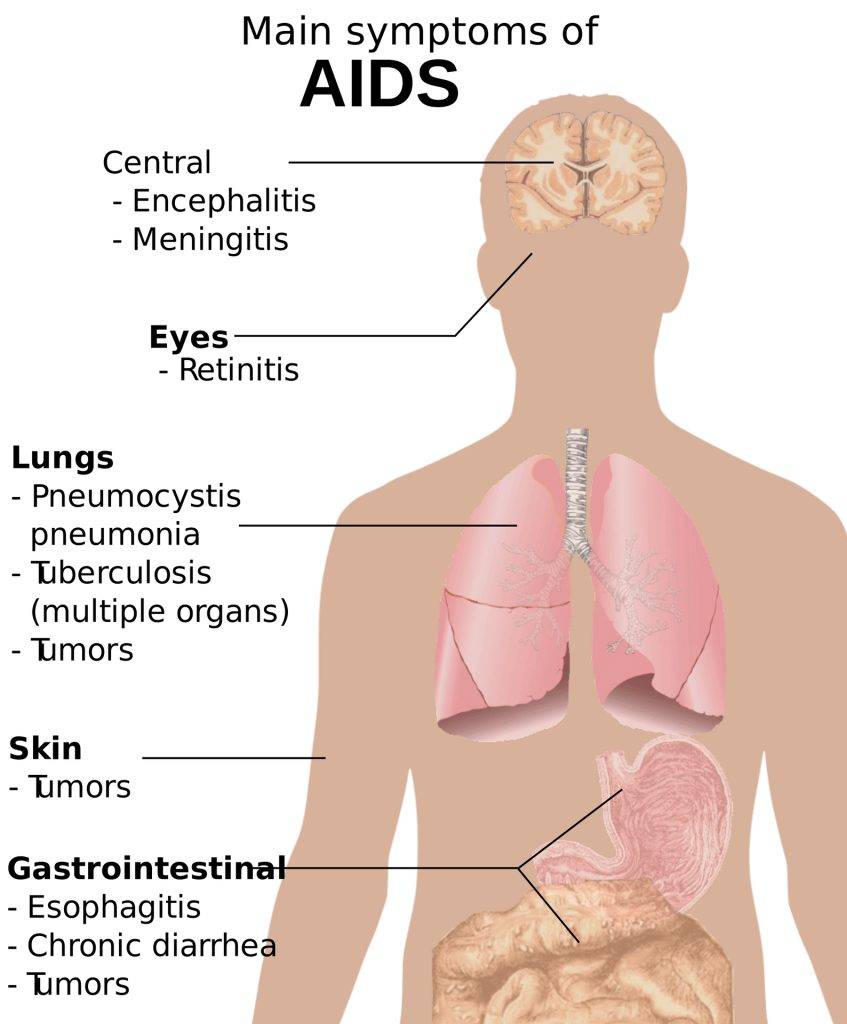 sintomi principali AIDS