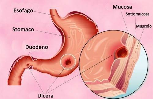 Farmaci antiulcera - L'ulcera peptica può riguardare la mucosa di stomaco o duodeno, più raramente dell'esofago