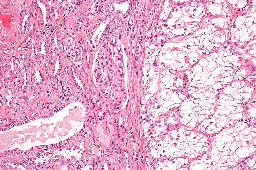 Sezione istologica di carcinoma renale a cellule chiare