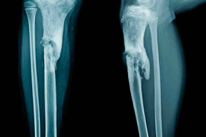 Aspetto radiografico dell'osteomielite