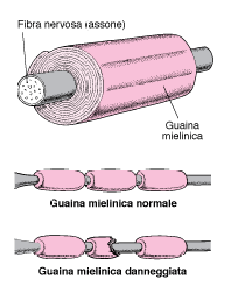 Demielinizzazione in soggetti affetti da sclerosi multipla